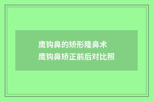 鹰钩鼻的矫形隆鼻术 鹰钩鼻矫正前后对比照